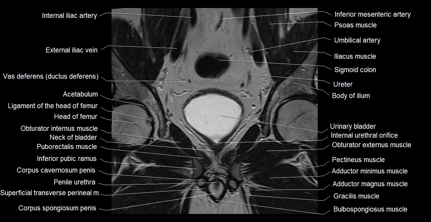 MRI coronal cross sectional anatomy male pelvis image 18.webp